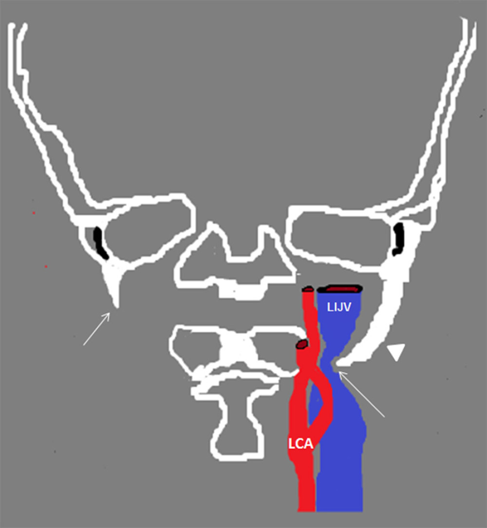 Summary diagram of the anatomical structures involved in stylo-jugular venous compression syndrome. The left internal jugular vein (LIJV) is compressed on the external side (long arrow) by the ipsilateral styloid process (SP; arrow head) against the transverse process of C1. The right SP is indicated with the short arrow. LCA – left carotid artery.