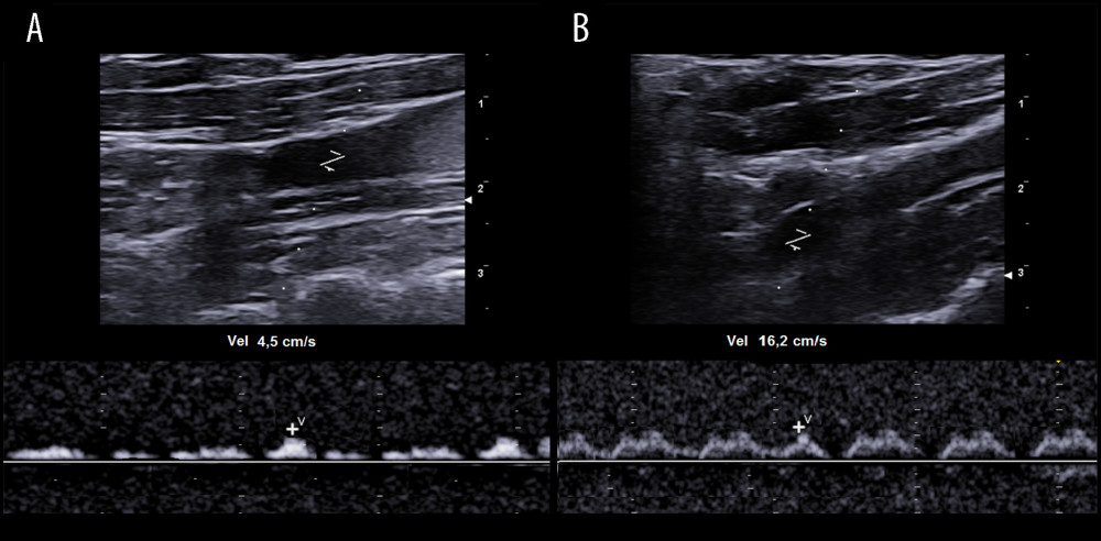 Left internal jugular vein (LIJV) duplex Doppler ultrasound. (A) The peak speed velocity (PSV) measurement in the prestenotic tract shows severe flow congestion, and (B) the PSV increase can be seen in the poststenotic tract.
