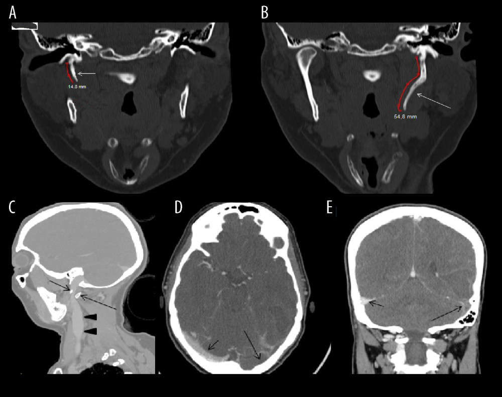 Cerebral multidetector computed tomography-angiography. (A) Coronal plane reconstruction shows a regular length and course of the right styloid process (SP; arrow). (B) The left SP (arrow) shows a longer length than the norm. (C) Sagittal plane reconstruction shows the left SP (short arrow) compressing the left internal jugular vein (LIJV; arrow heads) against the transverse process of C1 (long arrow). (D) In the axial acquisitions after contrast medium injection, the left transverse venous sinus does not show enhancement because it is thrombotic (long arrow), while the contralateral transverse venous sinus is impregnated by contrast medium (short arrow). (E) Thrombosis of the left transverse sinus (long arrow) is also well highlighted in the coronal plane reconstructions, which show normal impregnation of the right transverse venous sinus (short arrow).
