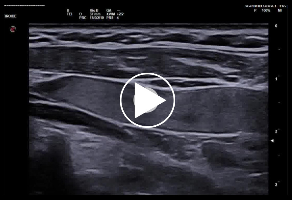 B-Mode ultrasound. The left internal jugular vein shows a very slow flow in the prestenotic section.
