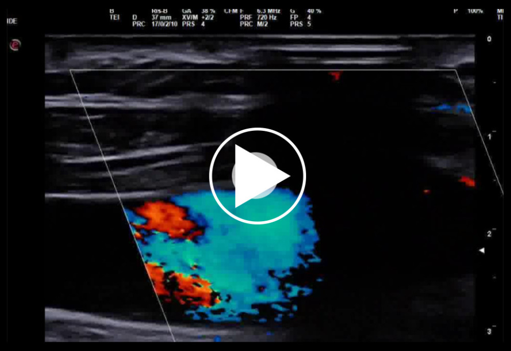 Color Doppler ultrasound. The right left internal jugular vein appears dilated with regular flow.