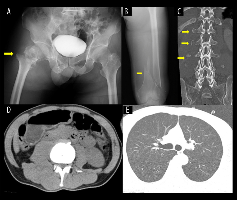 Radiographical findings of the major fractures and the lungs. Radiographs showing right trochanteric femoral fracture (A) and left distal femoral fracture (B). Computed tomography (CT) scans showing right lumbar transverse process fractures (C), and slight hemorrhage of right psoas major muscle by the right lumbar transverse process fracture, (D), and no findings of pneumonitis (E).