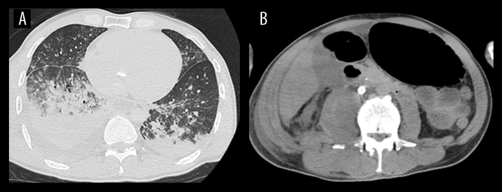 Postmortem computed tomography findings of the chest and abdomen. (A) Bilateral dorsal pulmonary congestion. (B) Heterogeneous low-density mass in the right psoas muscle.