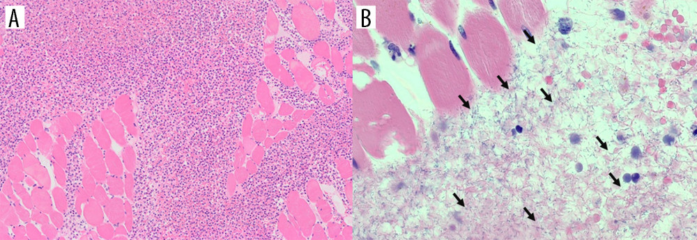 Microscopic findings of the psoas abscess at autopsy. (A) Light micrograph with hematoxylin and eosin staining showing psoas abscess and inflammatory cell infiltration by neutrophils and mononuclear cells. (B) At a higher magnification, numerous bacilli (arrows) are scattered.
