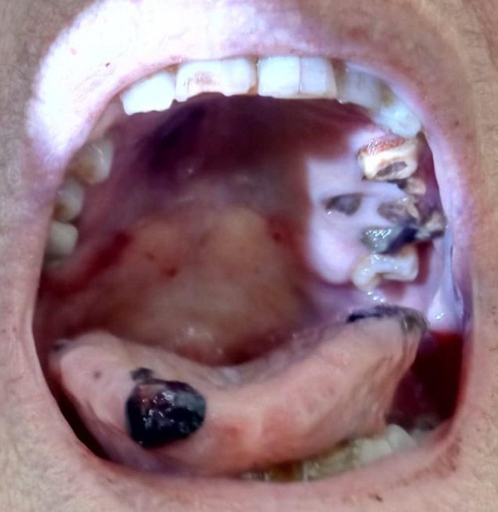 Petechial lesions of the palate and hematomas of the tongue on admission to our unit.