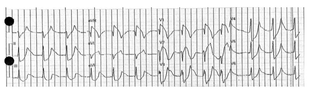 Presenting EKG obtained by EMS. Wide QRS complex with a rate of 74 beats per minute, Right axis deviation, absent P waves, ST depressions in inferior leads, T wave wide peaking/tenting, elevated J point in the septal leads with a type I Brugada pattern in V1–V2 with a nonspecific intraventricular conduction delay.