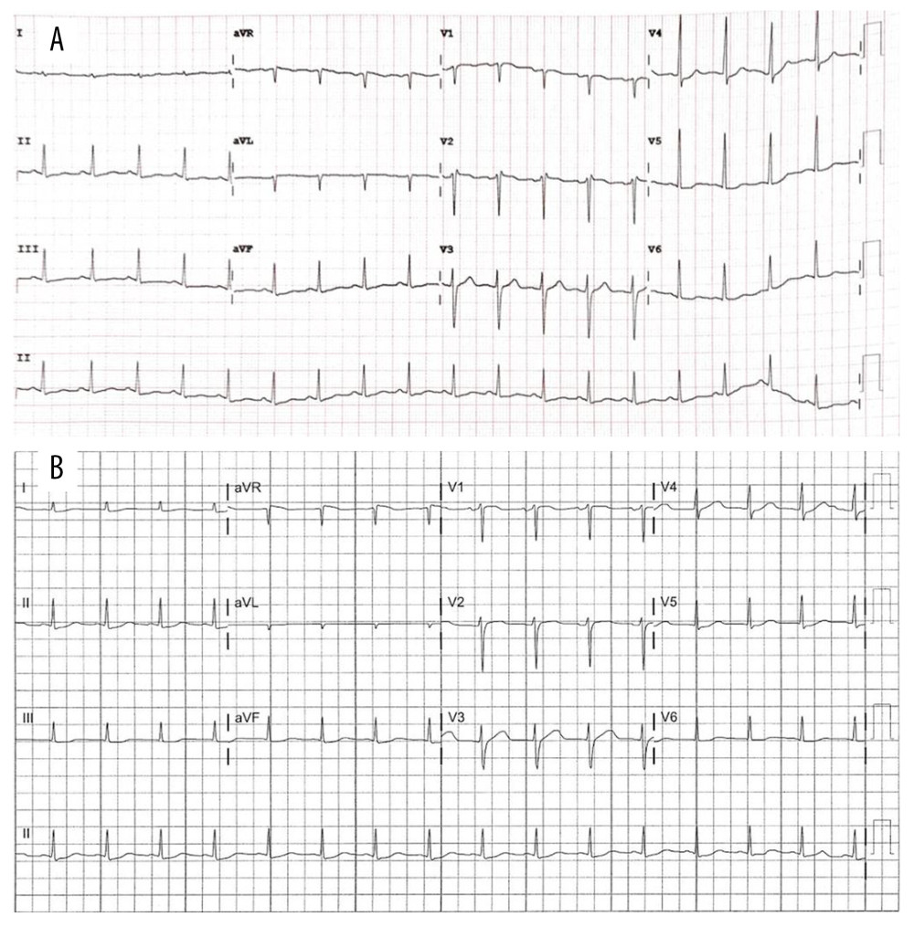 (A, B) Serial ECG when electrolyte and metabolic derangements were corrected. Normal sinus rhythm with a rate of 94 beats per minute. Narrow complex with a normal axis and normal PR interval. The both the hyperacute T wave abnormalities and Brugada pattern have resolved.