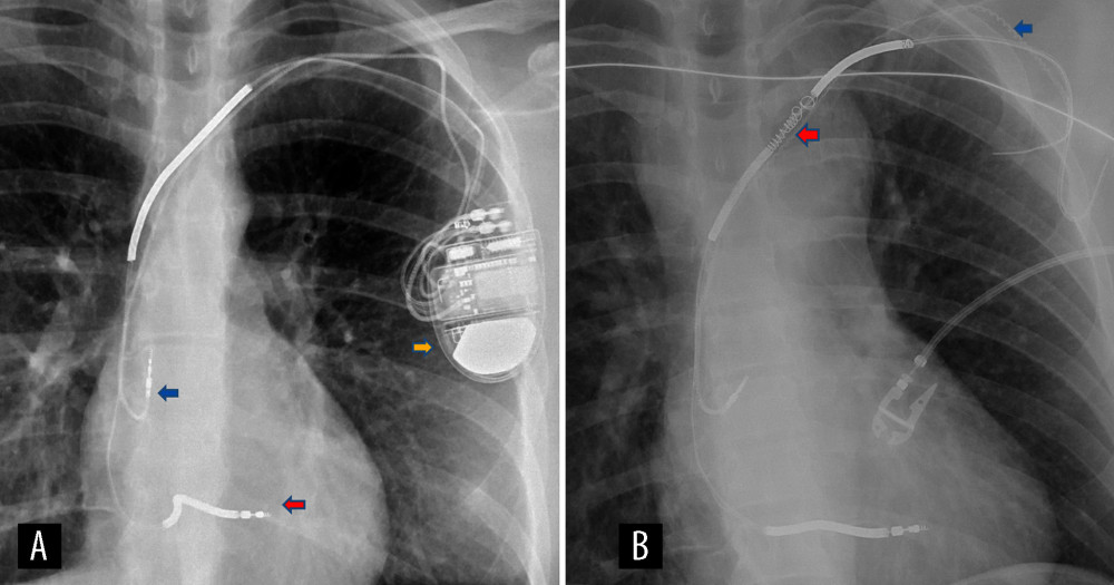 Chest X-ray before implantable cardioverter-defibrillator (ICD) extraction (A) showing pulse generator (Evera S DR, Medtronic, Inc, Minneapolis, MN, USA) (orange arrow) attached to right atrial pace-sense lead (5076 Capsure Fix Novus, Medtronic, Inc, Minneapolis, MN, USA) (blue arrow) and right ventricular defibrillator lead (6947 Sprint Quattro Secure, Medtronic Inc, Minneapolis, MN, USA) (red arrow). Chest X-ray after transvenous lead extraction attempt (B) showing removal of Medtronic device generator and unwinding of right atrial pace-sense lead (blue arrow) and right ventricular defibrillator lead (red arrow).