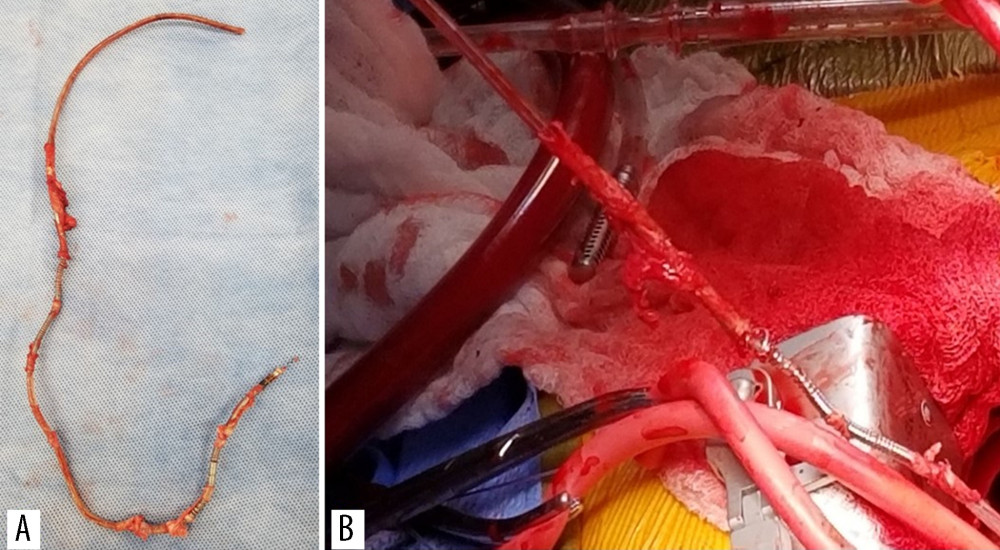 Extracted implantable cardioverter-defibrillator lead with adherent segments of innominate vein (A). Innominate vein avulsion over the lead during surgical extraction (B).