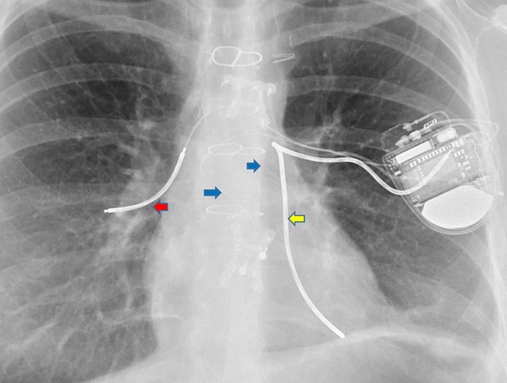 Chest X-ray after surgical extraction and implantation of an epicardial implantable cardioverter-defibrillator (ICD) pulse generator system (Visia AF MRI, Medtronic, Inc, Minneapolis, MN, USA) with 2 unipolar single-coil ICD leads (first lead is 6937A, Medtronic, Inc, Minneapolis, MN, USA) placed along the right thoracic surface in the intrathoracic fascia lateral to the mammary gland; red arrow, and second lead is SQ 6996 (Medtronic, Inc, Minneapolis, MN, USA) placed along the left pericardial surface deep to the phrenic nerve; yellow arrow, and a single bipolar pace-sense epicardial electrode (Capsure Epi 4968, Medtronic, Inc, Minneapolis, MN, USA) placed on the anterior surface of the heart (blue arrows).