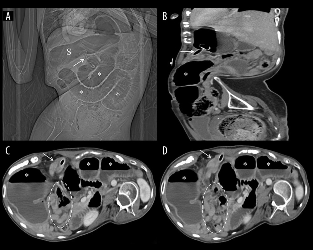 Abdominal computed tomography suggestive of volvulus around the gastrostomy tube. Scout image (A) showing the gastrostomy tube (arrow) in the distended stomach (C). Sagittal image (B) showing dilated small bowel loops (asterisk) in close relation to the tube (arrow). Consecutive axial images (C, D) showing swirl of jejunal loops (arrow) over the gastrostomy tube with resultant dilated proximal small bowel loops (asterisk) and completely collapsed small bowel loops distal to the tube (encircled). Note the levoscoliosis.