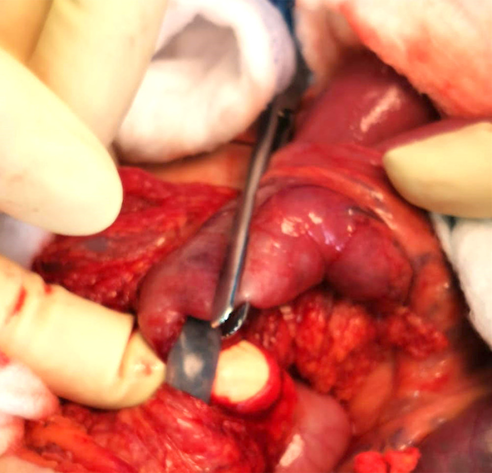 Laparotomy view showing the small bowel loops.