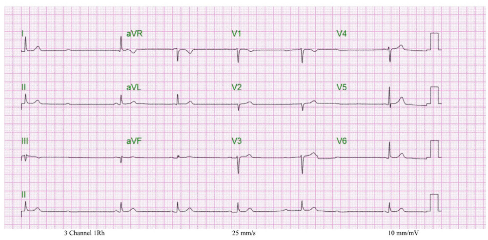 Electrocardiogram 2 hours after admission showed a Mobitz type I, 2nd-degree atrioventricular block.