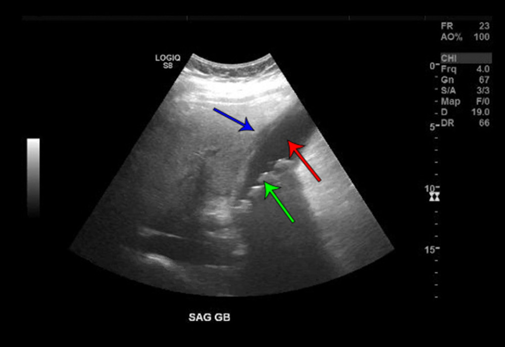 Abdominal ultrasonography showed cholelithiasis (green arrow) in the gallbladder cavity (red arrow) with pericholecystic fluid and the gallbladder-wall thickening demonstrated acute cholecystitis (blue arrow) with no significant bile duct dilatation.