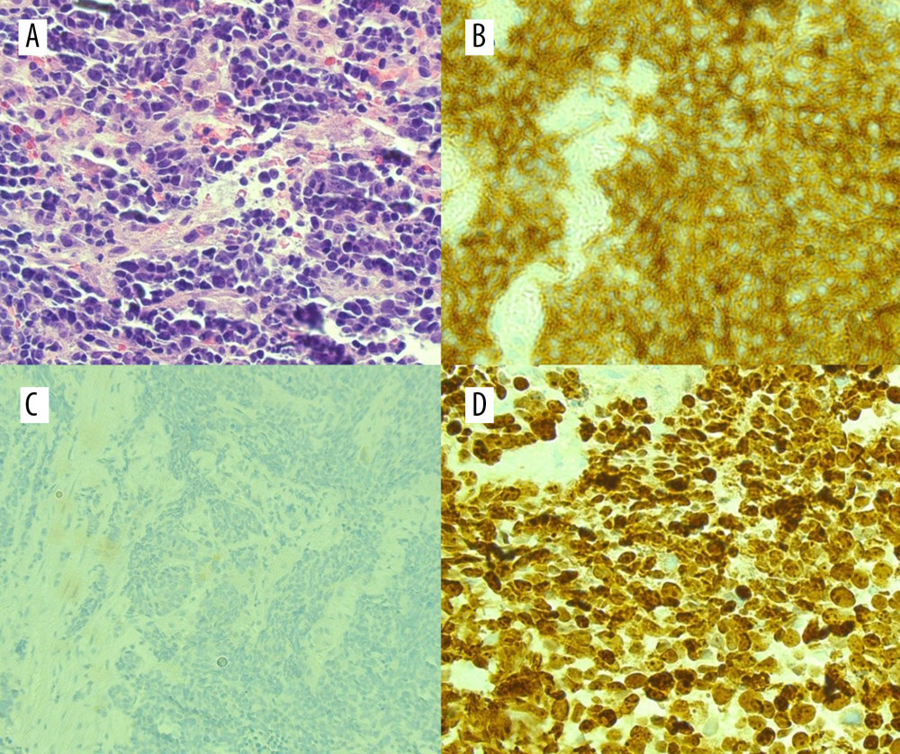 Histopathology of liver biopsy specimen showing (A) hematoxylin and eosin staining and immunohistochemical staining positive for (B) synaptophysin, (C) chromogranin, and (D) Ki-67.