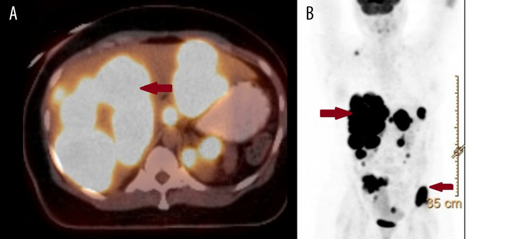 (A, B) PET/CT of the patient showing multiple metastatic lesions in liver, right breast, both kidneys, and iliac bone (arrows).