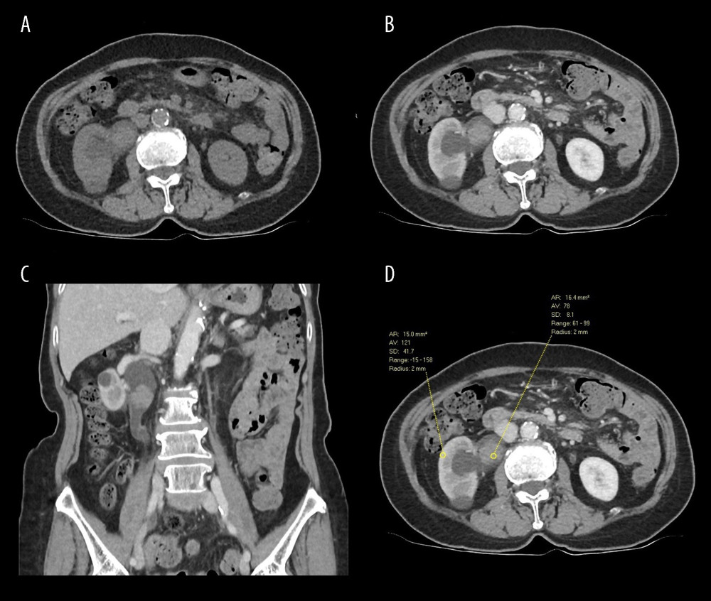 (A) Pre-contrast and (B, C) post-contrast axial and coronal CT intravenous pyelogram in nephrographic phase. A lobulated mass seen in the right renal pelvis, with post-contrast enhancement that is less than that of normal renal parenchyma. There is associated mild hydronephrosis. HU measurement is shown in (D), with a tumor-to-kidney attenuation ratio of 0.64.