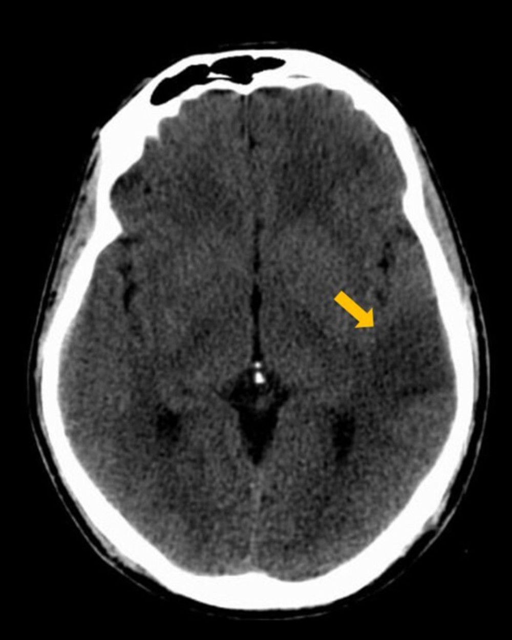 Non-contrast head computed tomography on second Emergency Department visit revealed hypodensity in the left temporal lobe.