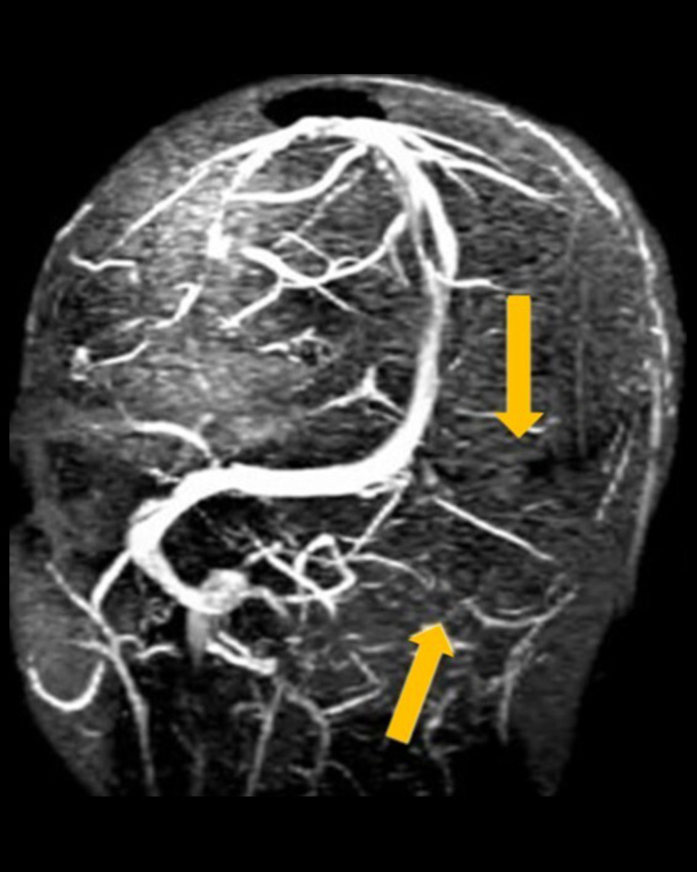 Magnetic resonance venography of the brain on admission revealed acute venous thrombosis involving the left transverse and sigmoid sinuses and left proximal jugular bulb.