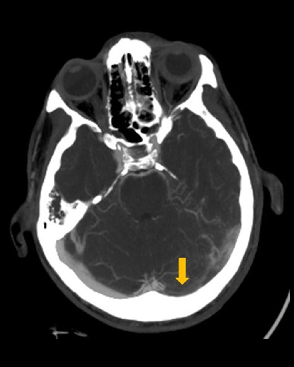 Computed tomography venography of the brain revealed an absence of flow at the level of the left transverse sinus, while showing preserved flow on the right transverse sinus.