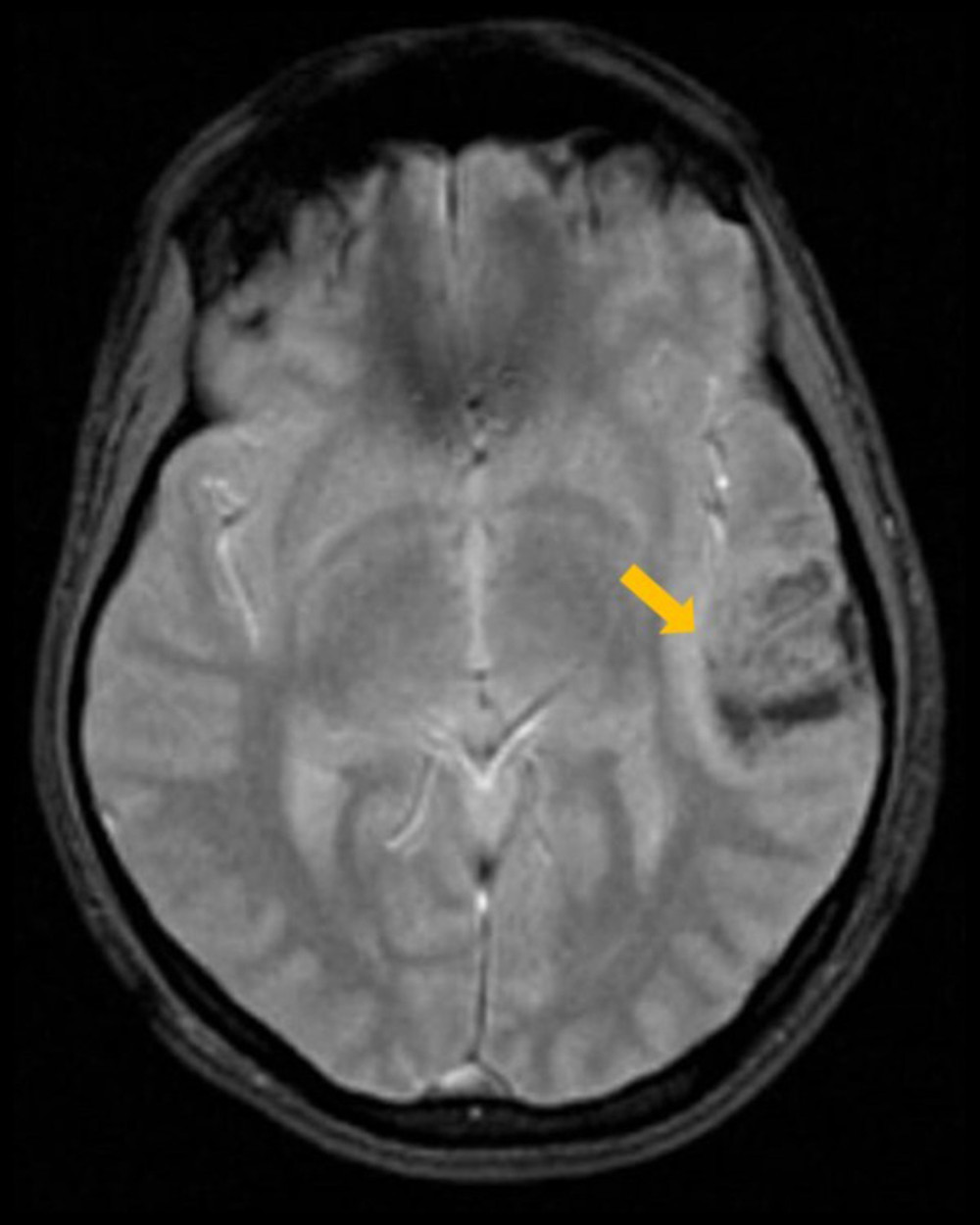 Gradient echo brain sequence repeated on day 6 of admission revealed the development of petechial hemorrhages within the core of the venous ischemic region of the left temporal lobe.