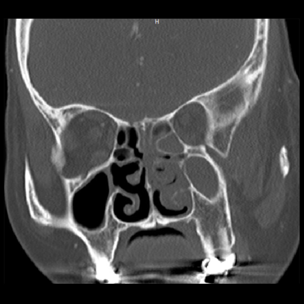 Coronal computed tomography scan shows fluid levels in the left maxillary sinus, sinus cavity, and ethmoid air cells.