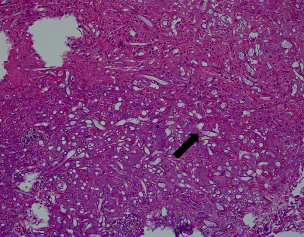 Slide stained with hematoxylin and eosin. Broad, disordered hyphae (arrow) are penetrating through the cell wall and but not into the structures [7].