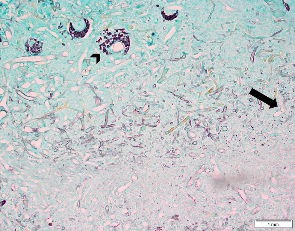 Slide stained with Grocott/Gomori methenamine silver (GMS). The spores (arrowhead) have a black color. Hyphae (arrow) often stain poorly with GMS and here they have a characteristic 90%-angle branching pattern [7].