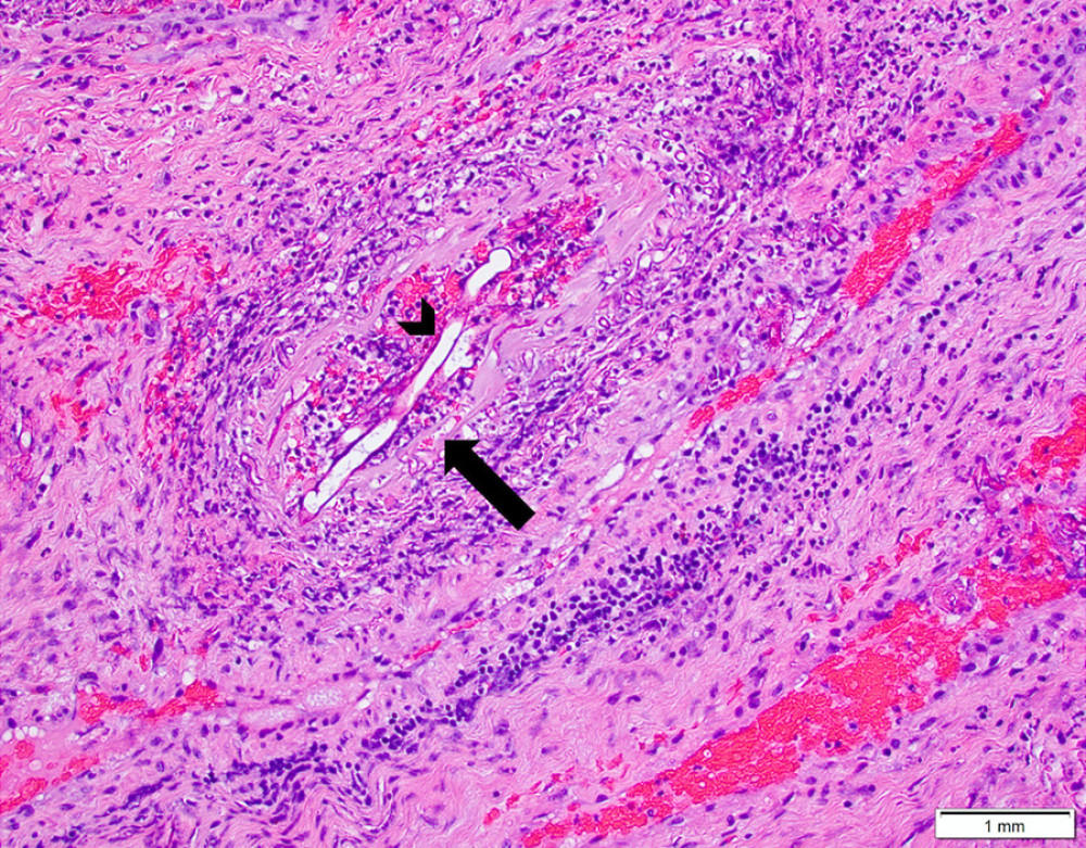 Slide stained with hematoxylin and eosin stain that shows angioinvasion of mucormycosis. Hyphae are seen invading the blood vessel wall (arrow) and the inside of the vessel lumen (arrowhead).