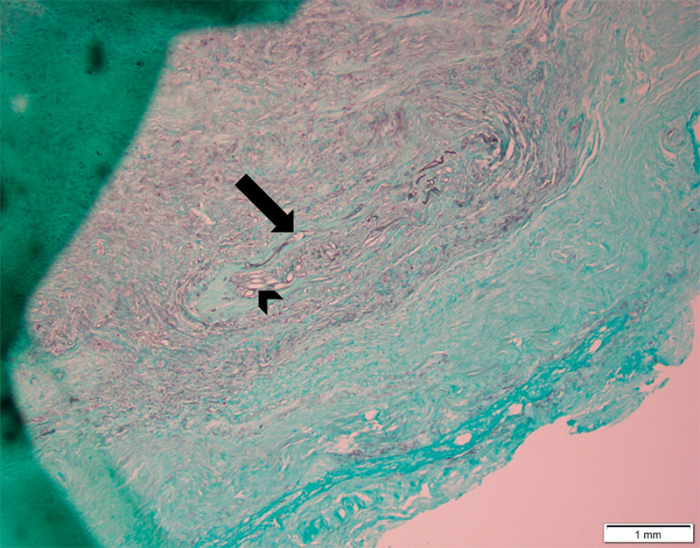 Slide stained with Grocott/Gomori methenamine silver that shows angioinvasion of mucormycosis. Hyphae are seen in the blood vessel wall (arrow) and inside the lumen (arrowhead).