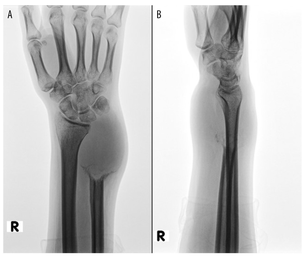 Antero-posterior (A) and latero-lateral (B) X-ray images of the right forearm and wrist demonstrate a lytic expansile lesion involving the distal epiphysis of the ulna, which is completely consumed. „The osteolytic features are so prevalent as to give the roentgen-ray picture of a tabula rasa„ [17]. The lesion margins are irregular with an aggressive appearance and relatively broad zone of transition without sclerotic zones. There is no convincing periosteal reaction. No evidence of calcifications can be seen within the tumor stroma. The styloid of the radius, carpal bones, and bases of the metacarpal bones seem osteopenic; cortical bone is intact.