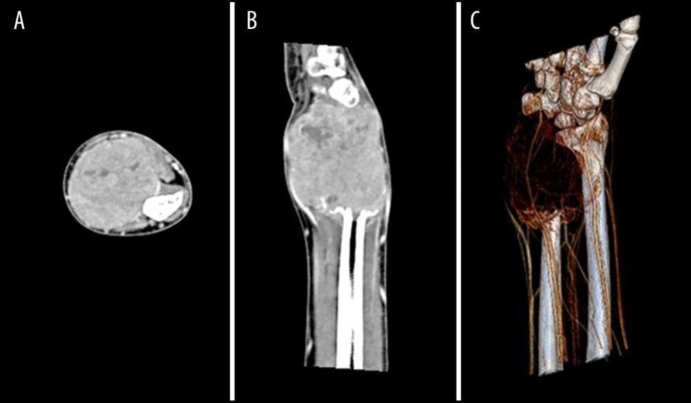 Postcontrast axial (A) and sagittal (B) CT slices confirmed an expansile lytic tumor of the distal ulna, with somewhat heterogeneous, partly cystic stroma, without calcifications. Significant contrast uptake is seen in the tumor stroma. No signs of infiltration of surrounding soft tissues. Volume Rendering Technique image (C) demonstrates lysis of the bone, abundant vascularization of the tumor, as well as major blood vessels diverging around the lesion.