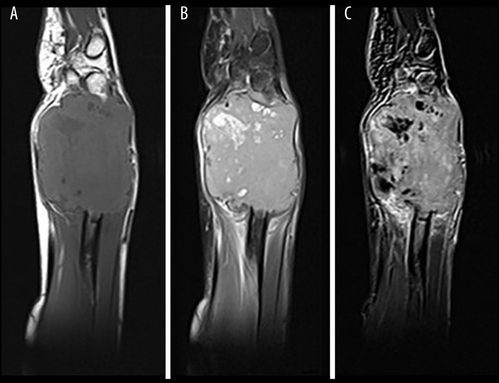 Sagittal MRI obtained using T1-weighted (A), proton-density-weighted, fat-saturated (B), and postcontrast subtracted T1-weighted (C) sequences demonstrates a large, irregular epiphyseal tumor of the distal ulna. The tumor stroma shows T1 hypointense, proton-density-fat-saturated hyperintense signal intensity, with internal cystic zones. The solid part shows avid contrast enhancement. Although signs of locally aggressive growth are evident, there are no signs of infiltration of surrounding tissues.