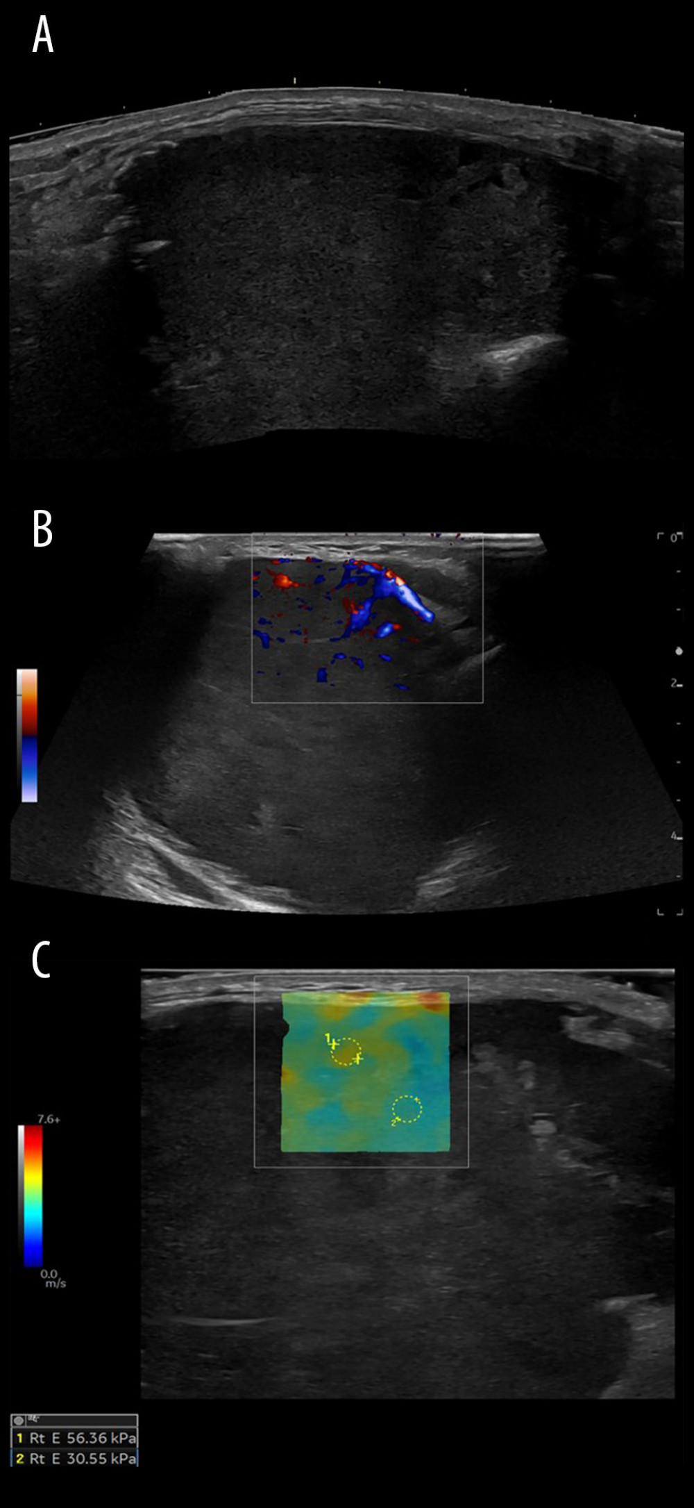 Images obtained during a core biopsy. Extended field-of-view B-mode image (A) shows an irregular hypoechoic mass in the distal ulna. Color Doppler flow imaging (B) demonstrates hypervascular tumor stroma with numerous sinusoidal vessels typical for giant cell tumor of bone. On shear-wave elastography (C), the color elastogram shows predominantly blue/cyan and cyan/green readings performed on 2 small areas of the superficial aspect of the tumor stroma (areas of low to intermediate stiffness, measuring 30–60 kPa).