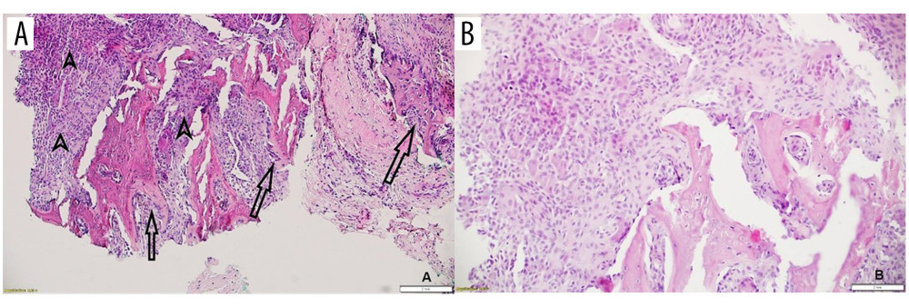 Hematoxylineosin-stained histological sections. (A) Magnification ×100. (B) Magnification ×200. Typical giant cell tumor of bone histology with multinuclear osteoclast-like giant cells (representing the neoplastic stromal cells; arrows) and mononuclear cells (arrowheads). Reactive woven bone spicules are apparent.
