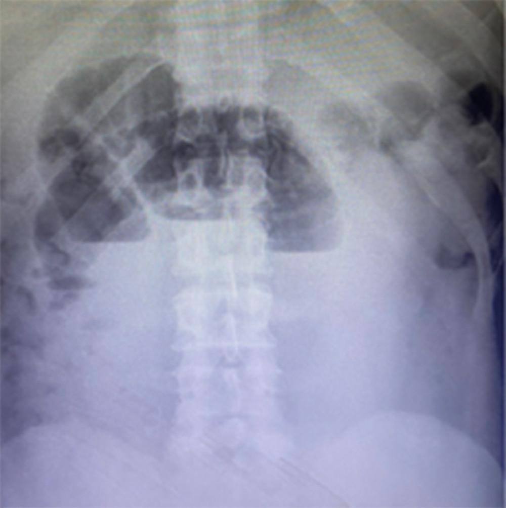 Abdominal X-rays taken with the patient erect show multiple air-fluid levels with dilated loops of small bowel.