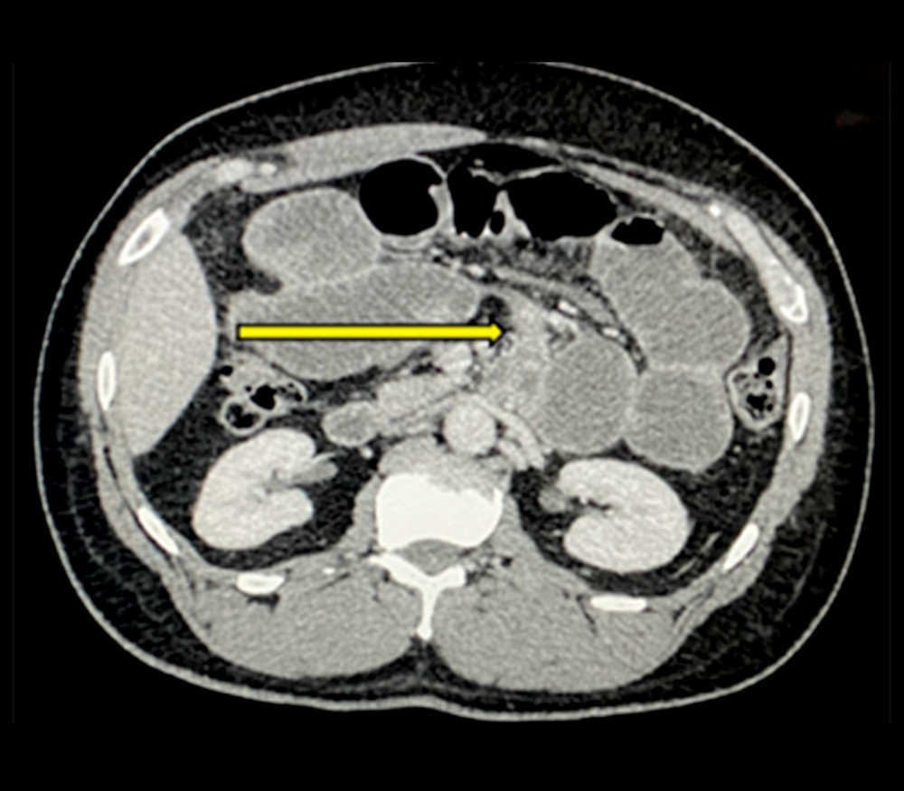 An axial computed tomography scan reveals the transition point to the left of fourth part of the duodenum (yellow arrow).