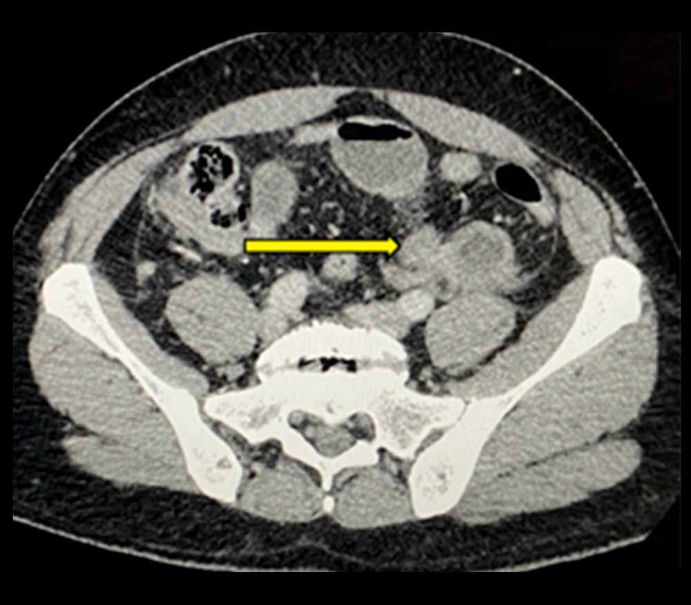 An axial computed tomography scan reveals the transition point in the left iliac fossa.