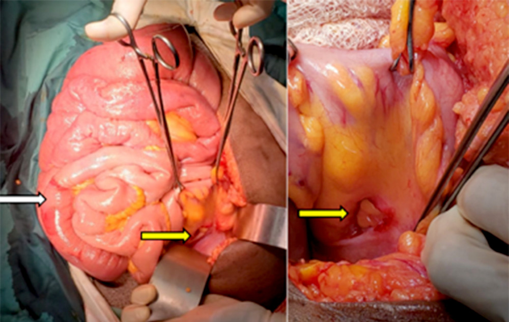 An intraoperative image shows the sigmoid mesocolon defect (yellow arrow) and transition point (white arrow).