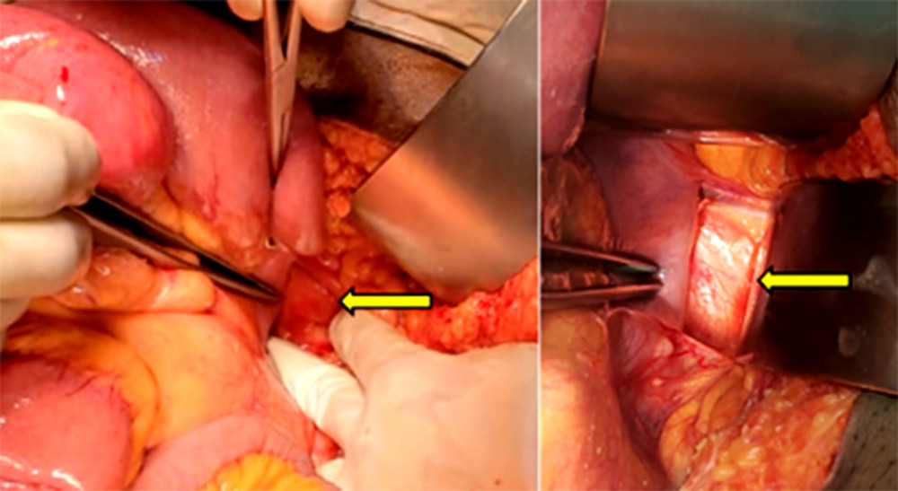 An intraoperative image shows the defect in the left paraduodenal area (yellow arrow).