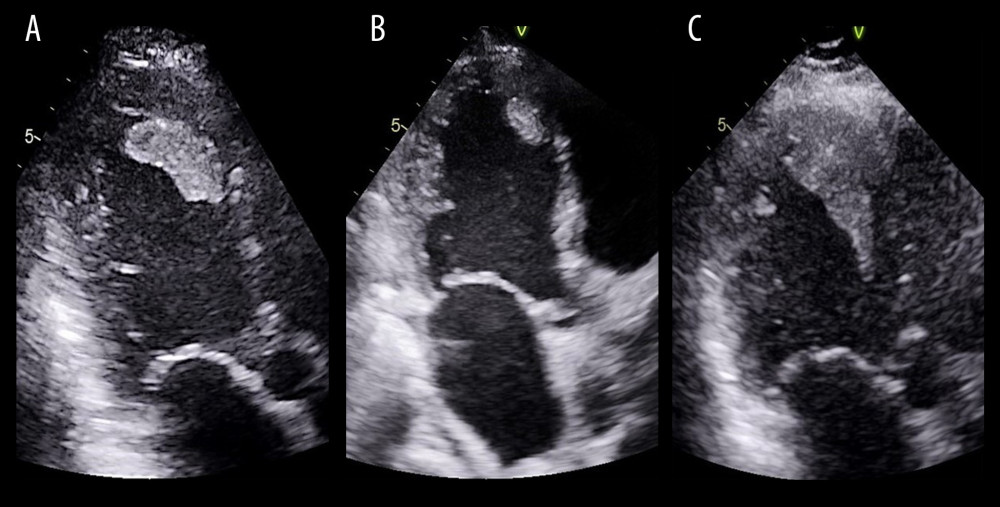 Apical 3-chamber views on the serial transthoracic echocardiograms. (A) The study was done at the index hospitalization showing a large thrombus against the distal anteroseptum and true LV apex. (B) Considerable thrombus regression after 4 months of oral warfarin. (C) This study was obtained 9 months after oral rivaroxaban (during the patient’s last hospitalization), showing a substantial increase in the thrombus’s side and extension into the left ventricular outflow tract.