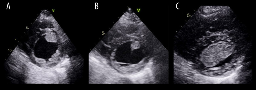Parasternal short-axis views in the mid-ventricular level on the serial transthoracic echocardiograms. (A) The study was done at the index hospitalization showing a large thrombus against the distal anteroseptum and true LV apex. (B) Considerable thrombus regression after 4 months of oral warfarin. (C) This study was obtained 9 months after oral rivaroxaban (during the patient’s last hospitalization), showing a substantial increase in the thrombus’s side, which is now occupying the entire LV apex.