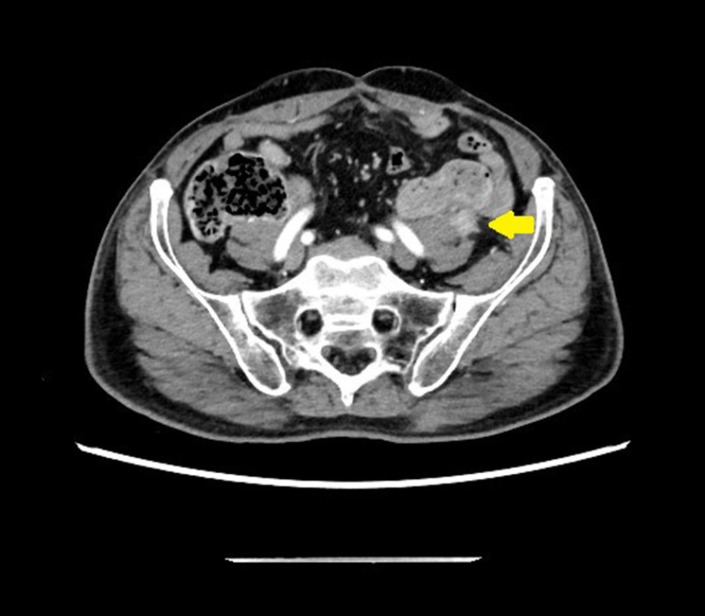 A 77-year-old man with a pulse granuloma of the descending colon. An abdominal contrast-enhanced computed tomography (CT) scan showing an irregular nodule on the dorsolateral side of the descending colon (arrow).