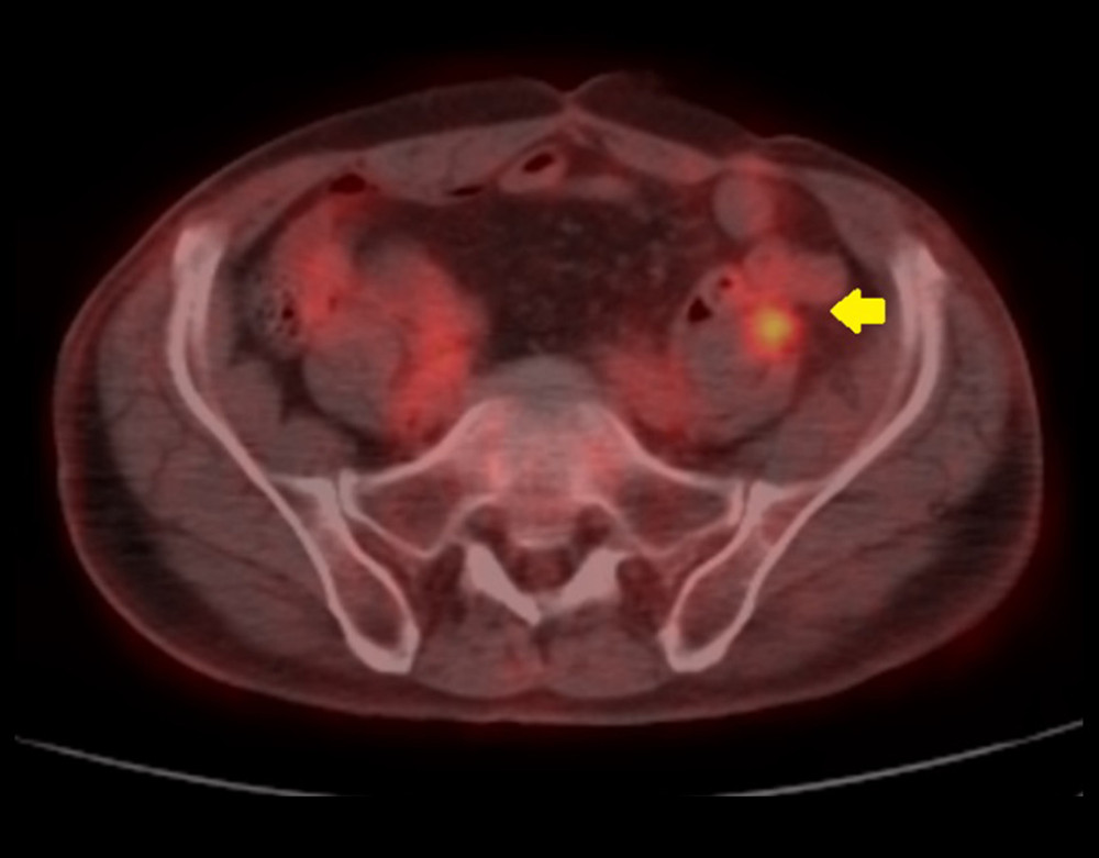 A 77-year-old man with a pulse granuloma of the descending colon. Fluorodeoxyglucose-positron emission tomography (FDG-PET) combined with computed tomography (CT) shows FDG accumulation in the area of the descending colon, with a maximum standard uptake value (SUV max) of 4.5 (arrow).