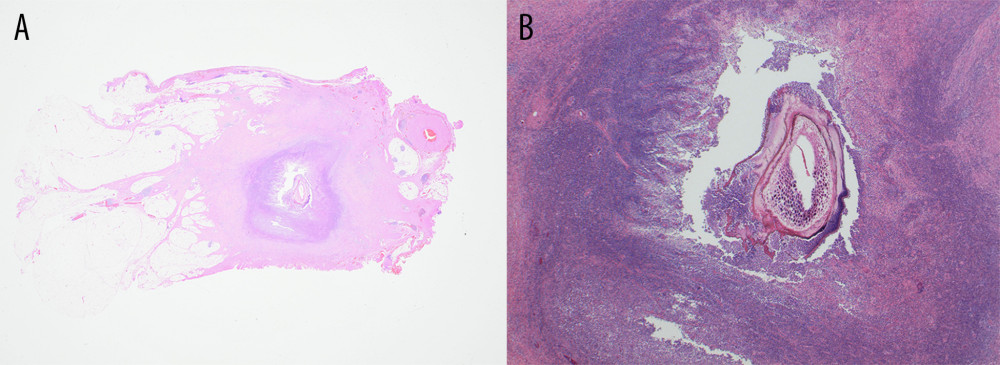 A 77-year-old man with a pulse granuloma of the descending colon. (A) Low-power photomicrograph of the histopathology of the excised descending colon nodule shows a benign granulomatous and fibrotic nodule, or pseudotumor, containing a legume seed in the center. There is no evidence of malignancy. Hematoxylin and eosin (H&E). Original magnification. (B) A higher-power photomicrograph shows the central legume seed, typical of a pulse granuloma. H&E. Magnification ×15.