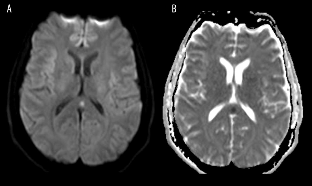 Magnetic resonance images of the brain without contrast. (A) Is a diffusion-weighted imaging sequence. (B) Shows apparent diffusion correlation. There is a focal area of diffusion restriction on the left in the splenium of the corpus callosum with reversal on the apparent diffusion coefficient map.