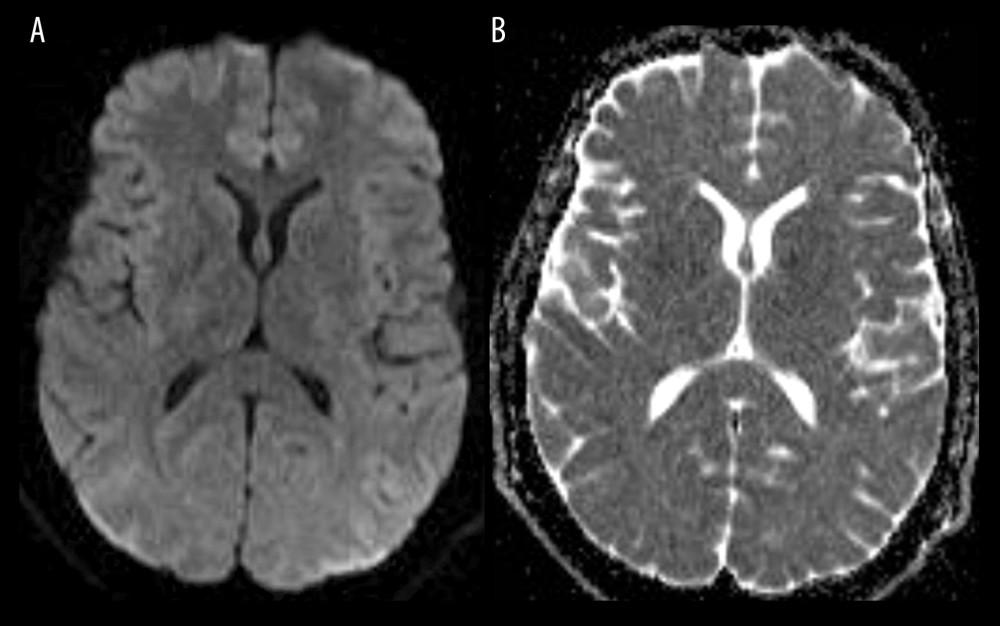 Follow-up magnetic resonance images of the brain after treatment with i.v. immunoglobulin, which show resolution of the focal area of diffusion restriction on both diffusion-weighted imaging (A) and apparent diffusion coefficient (B) maps.