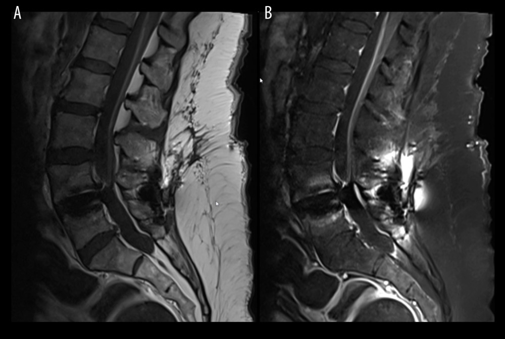 Magnetic resonance images of the lumbar spine without (A) and with (B) contrast show leptomeningeal enhancement along the conus medullaris and multiple ventral nerve roots.