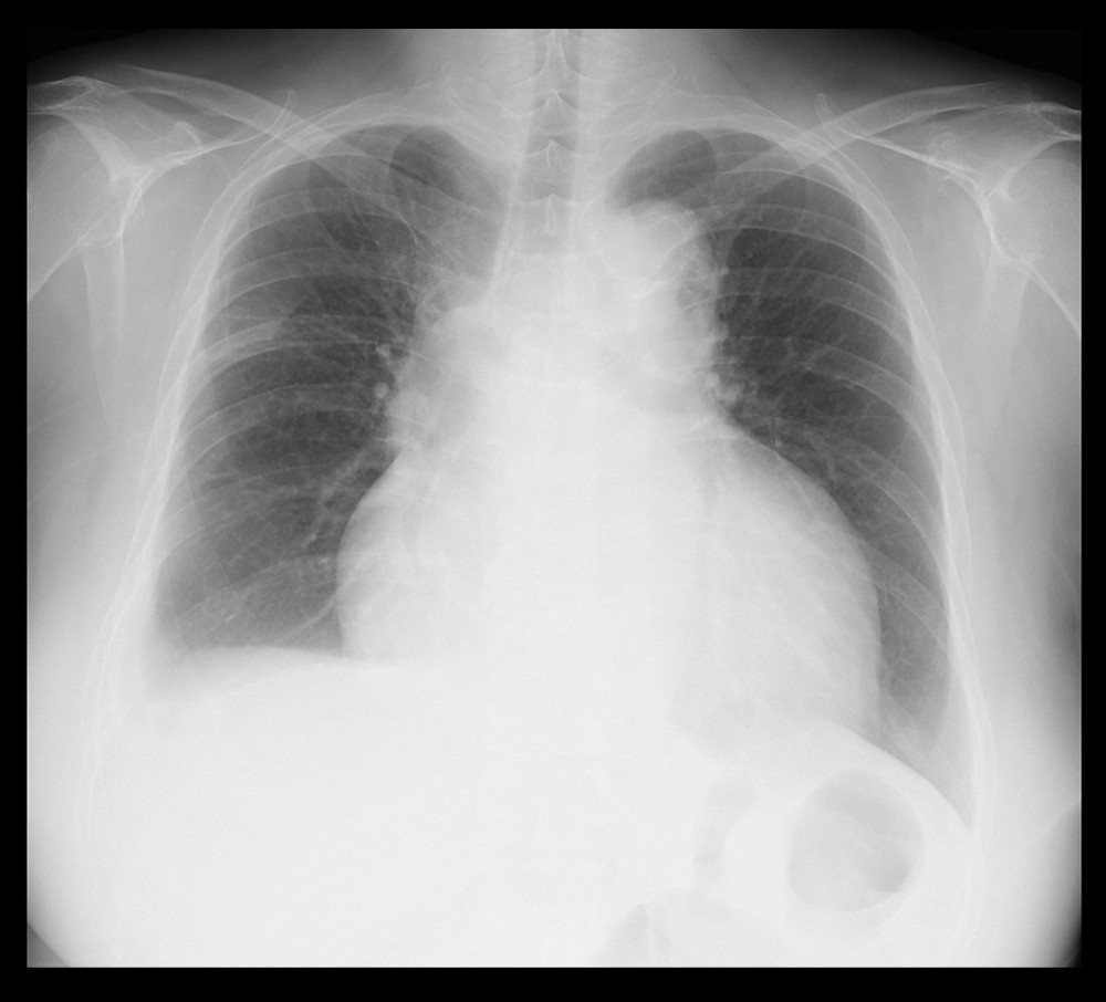 Chest X-ray – confirmation of cardiomegaly.