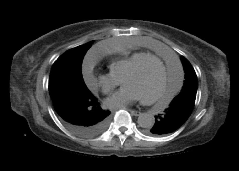 CT – observation of pericardial effusion.
